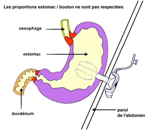 estomac